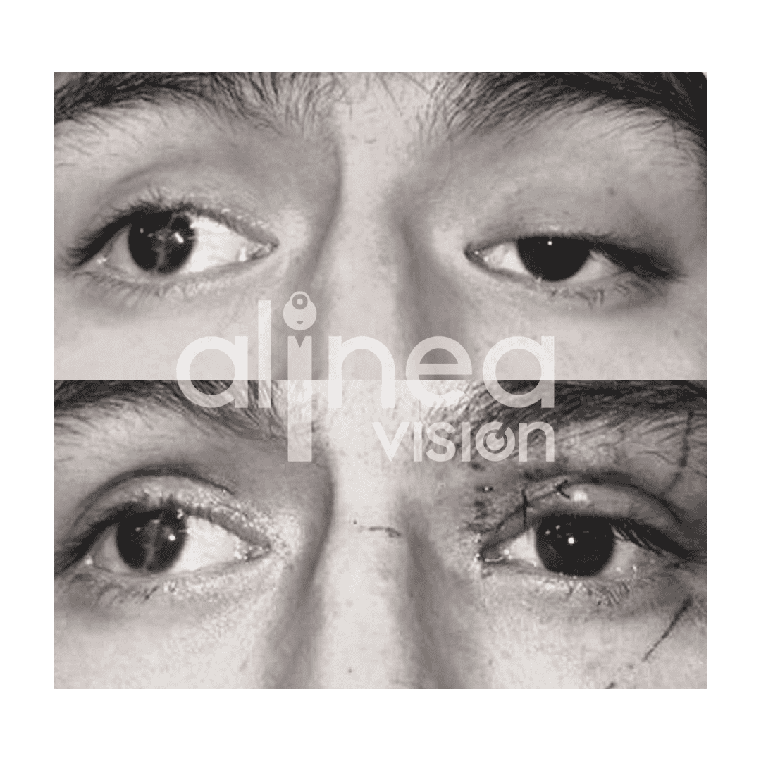 ¿Conoces sobre la Ptosis?